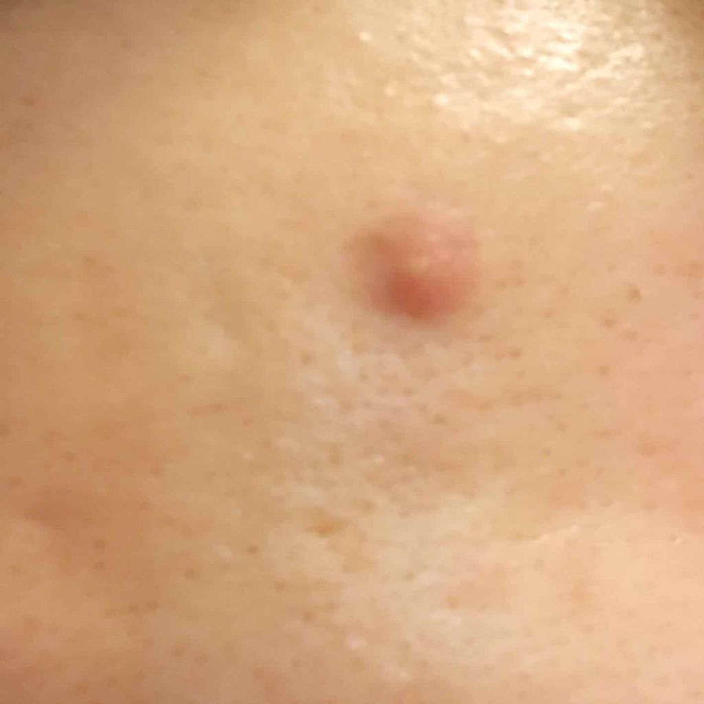 薬用 しみ 集中対策 美容液/メラノCC/美容液を使ったクチコミ(2枚目)