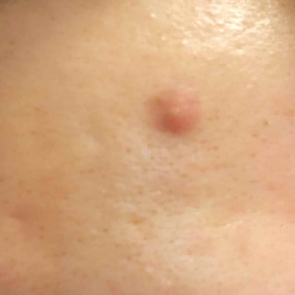 薬用 しみ 集中対策 美容液/メラノCC/美容液を使ったクチコミ(2枚目)