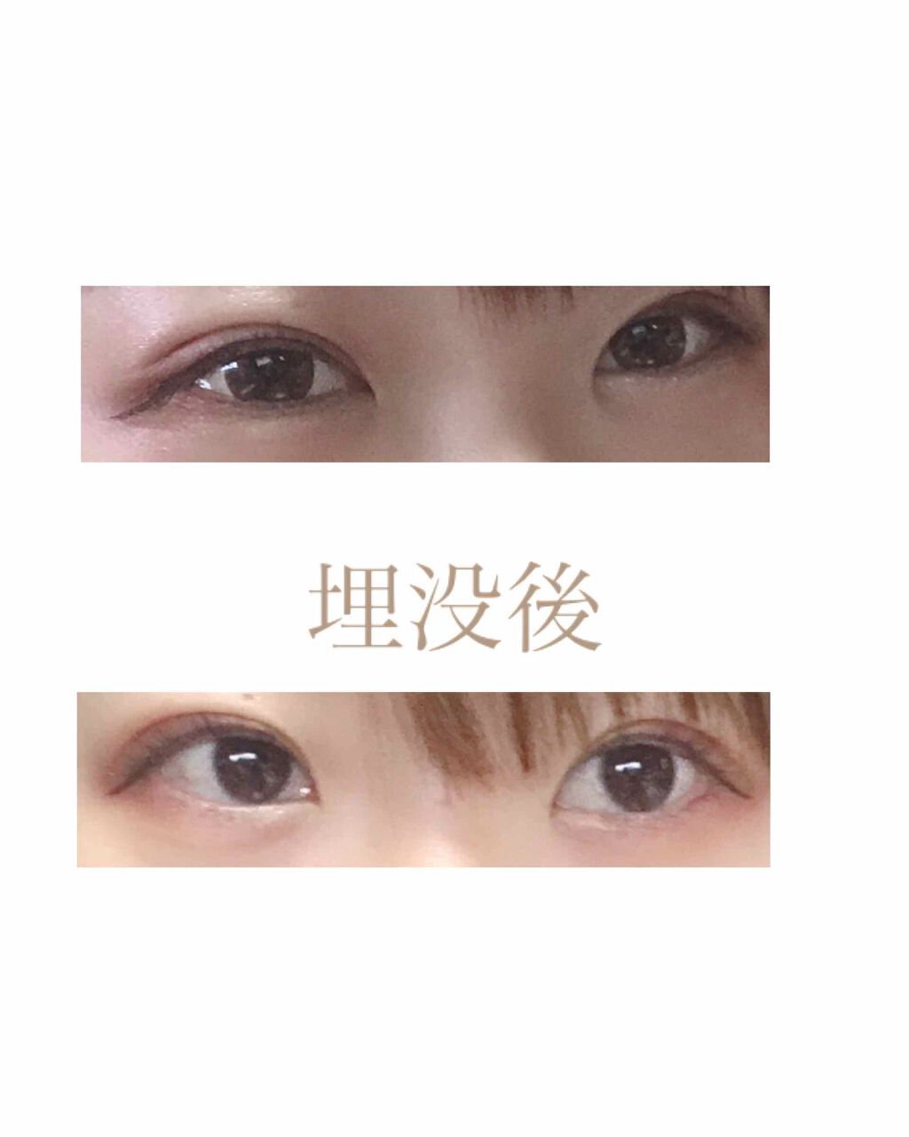 みるくてぃ on LIPS 「埋没前は絆創膏→アイプチ二度重ねで、元の奥二重の線が出つつも、..」(3枚目)