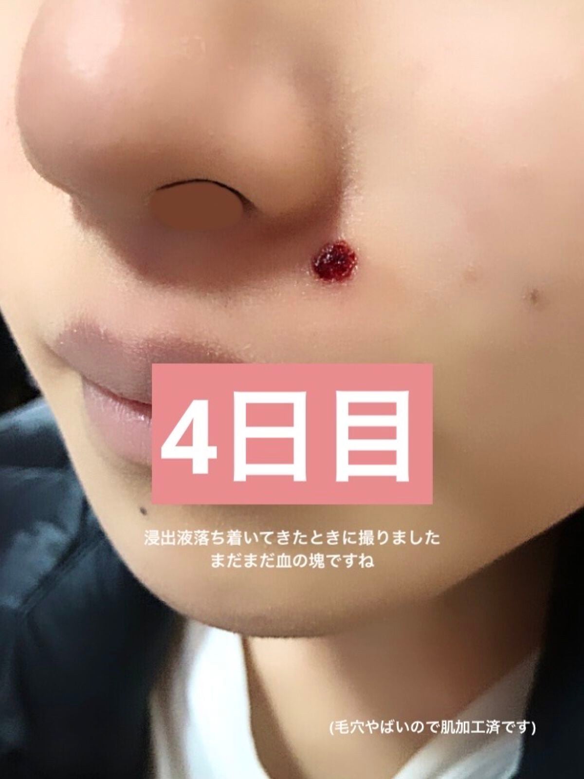 キズパワーパッド/バンドエイド/その他を使ったクチコミ(2枚目)