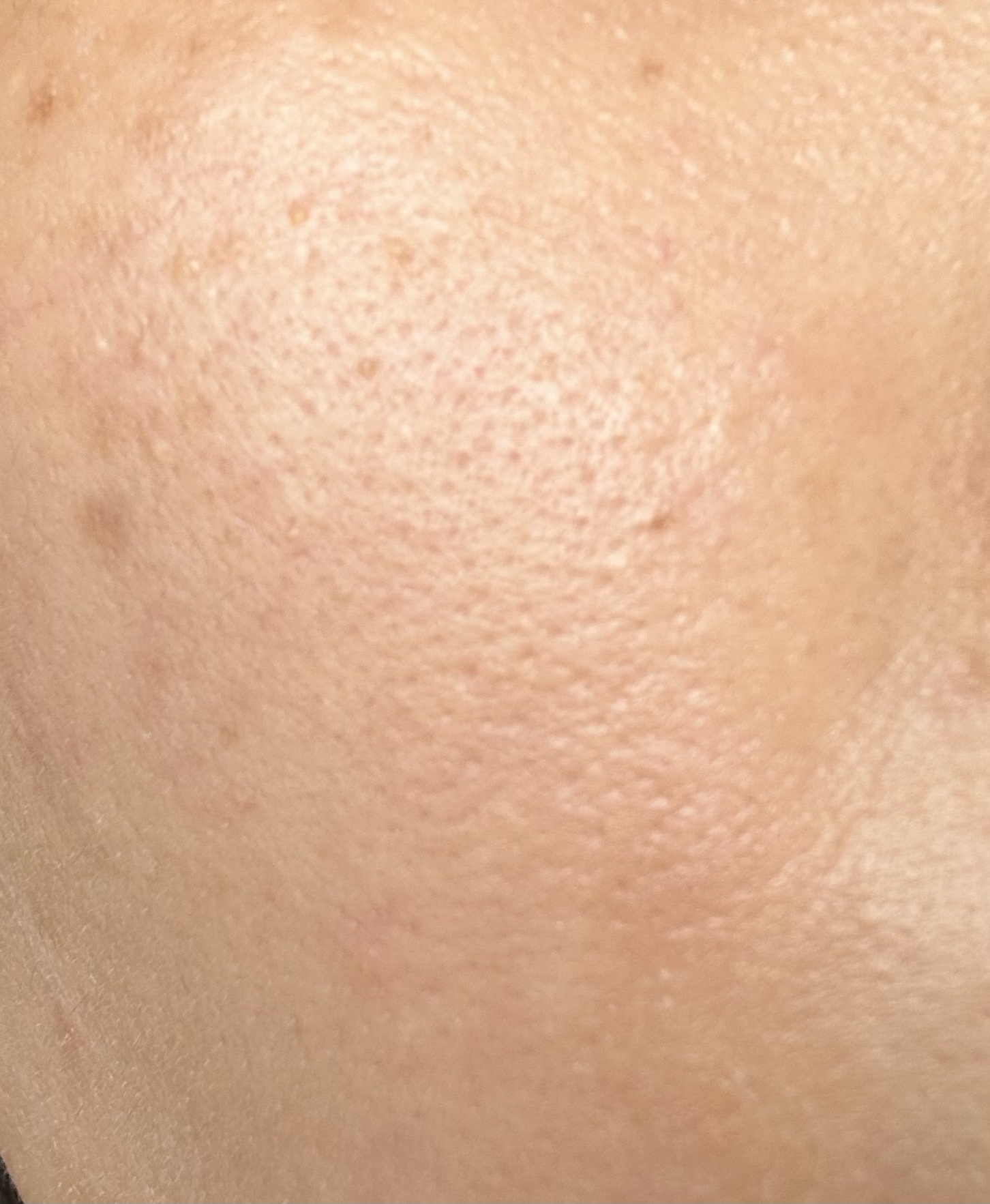 リードルショット100/VT/美容液を使ったクチコミ（2枚目）