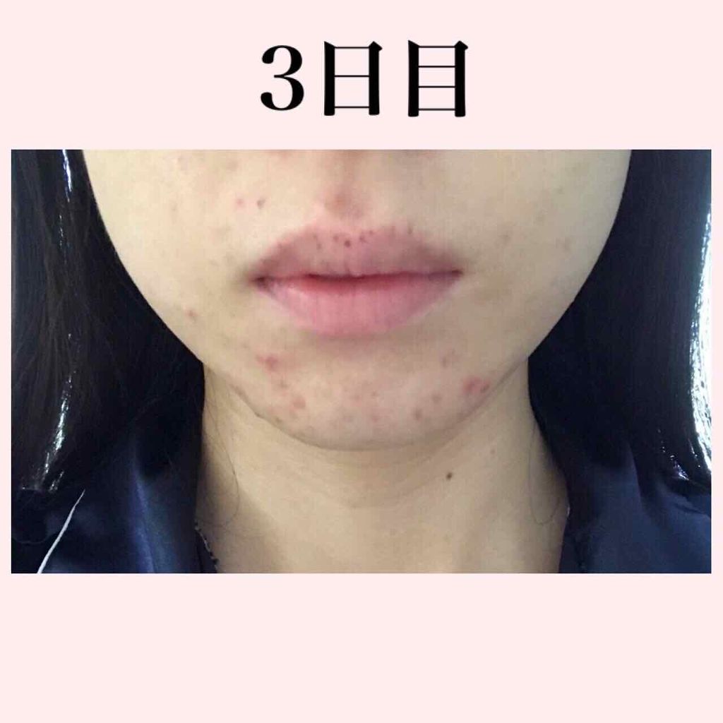 Pino On Lips 汚肌注意です 本日ニキビ撲滅週間3日目です 今日の朝の肌は Lips