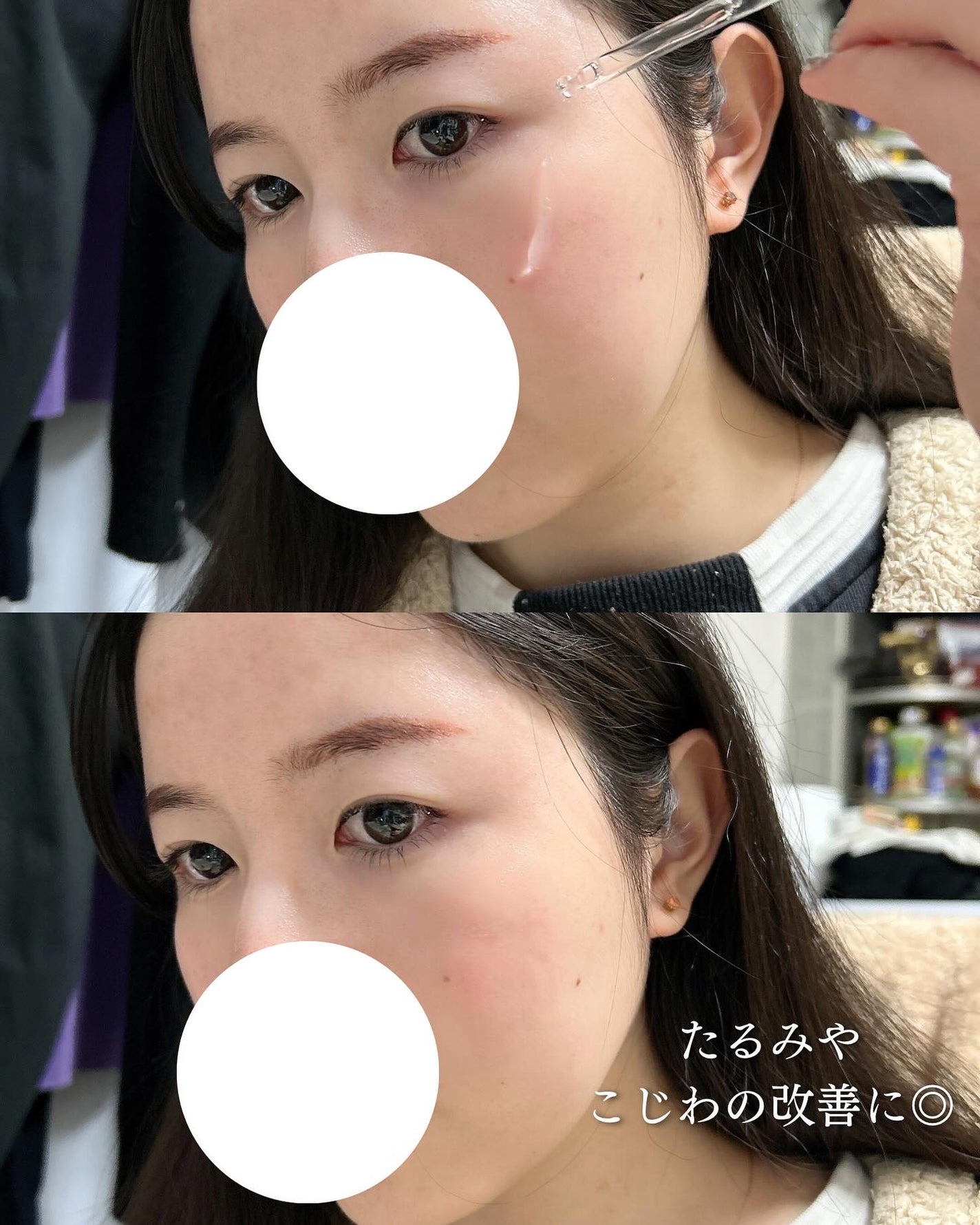 リマージ糸リフティングアンプル/REVENIP/美容液を使ったクチコミ(4枚目)