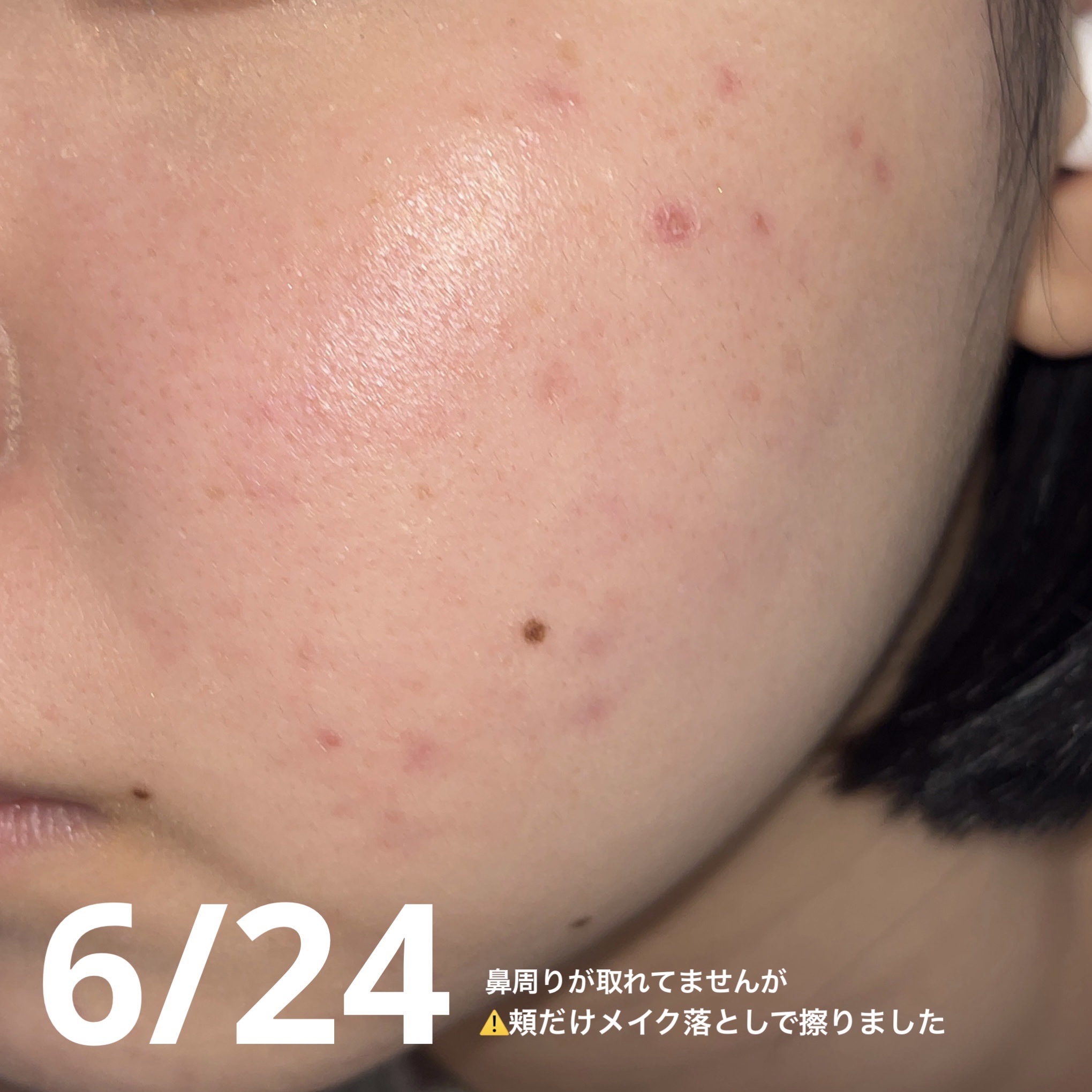 マジックティーツリーオイル/ブラン/フェイスオイルを使ったクチコミ（3枚目）