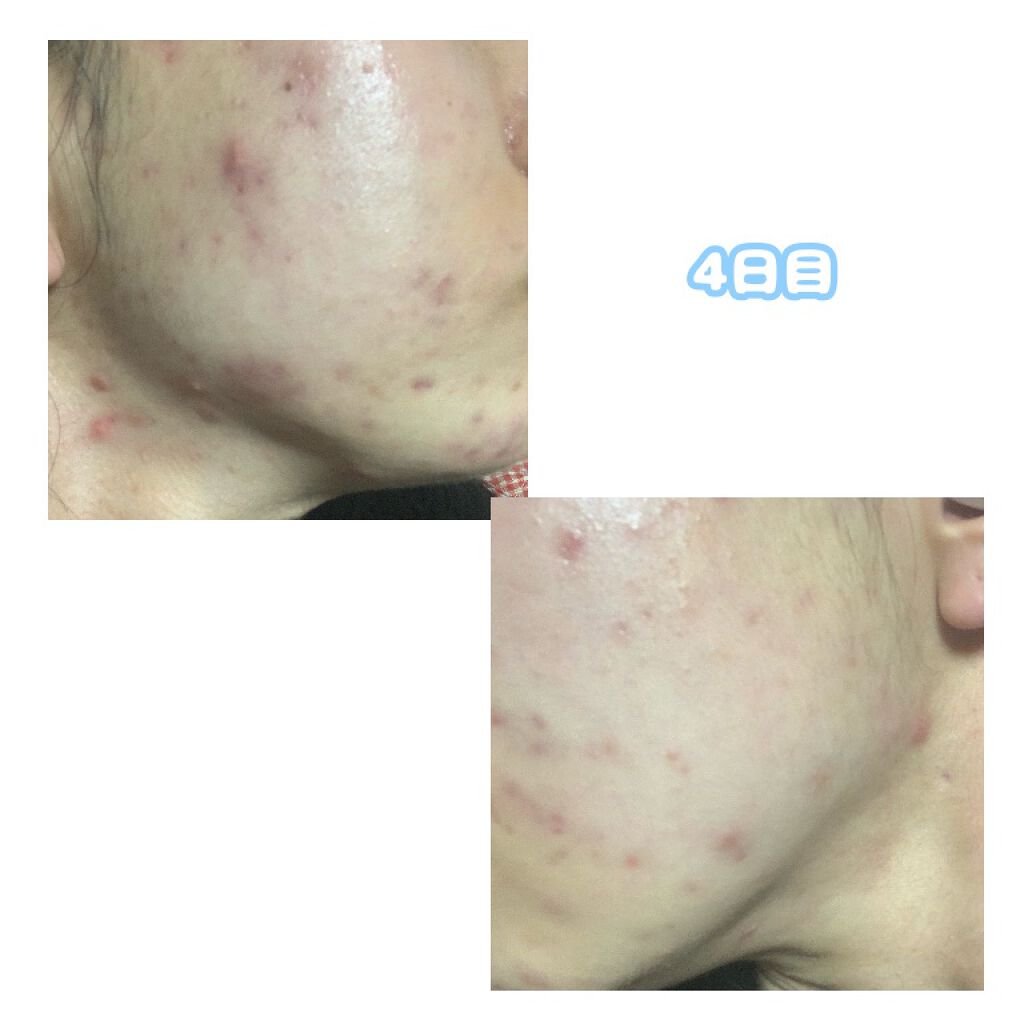 敏感肌用薬用美白美容液/無印良品/美容液を使ったクチコミ(5枚目)