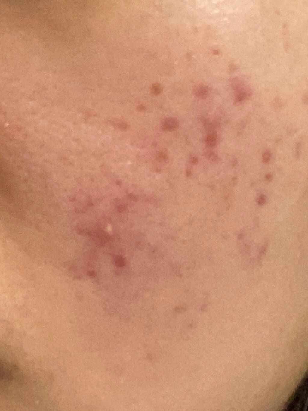 rrr on LIPS 「ニキビ跡が、、泣ニキビ跡ってどーやって治すんですか??#ニキビ..」(1枚目)