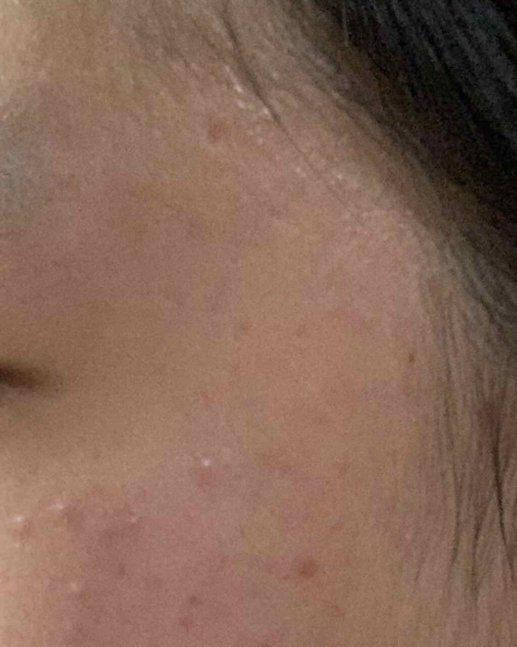 エピデュオゲル/マルホ株式会社/その他を使ったクチコミ（2枚目）