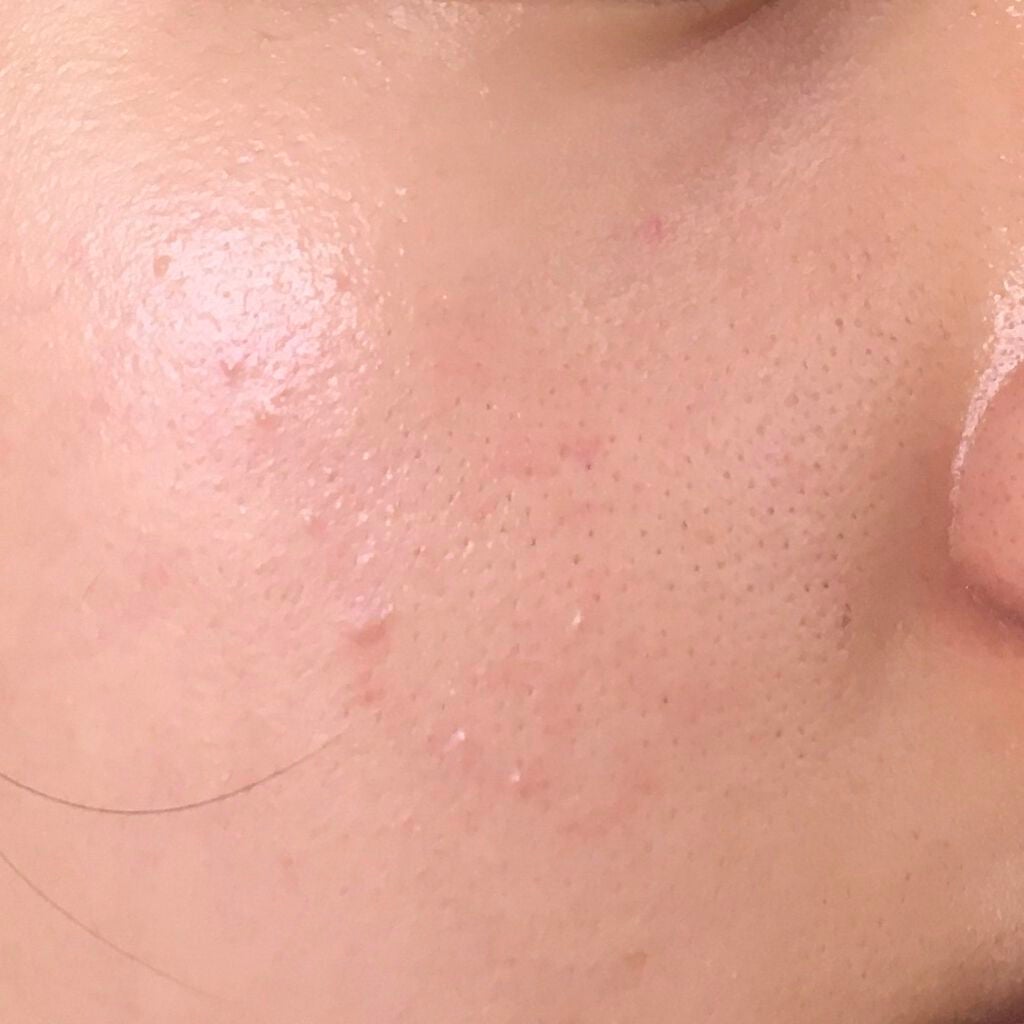 レチノールA 1% アドバンスドリバイタリゼーションクリーム/Life-flo/フェイスクリームを使ったクチコミ(1枚目)