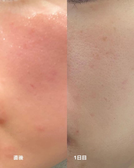 あずさ@スキンケアマニア on LIPS 「薄いシミは消えるのか?ピコスポットレポ1月半ばにUBクリニック..」(4枚目)