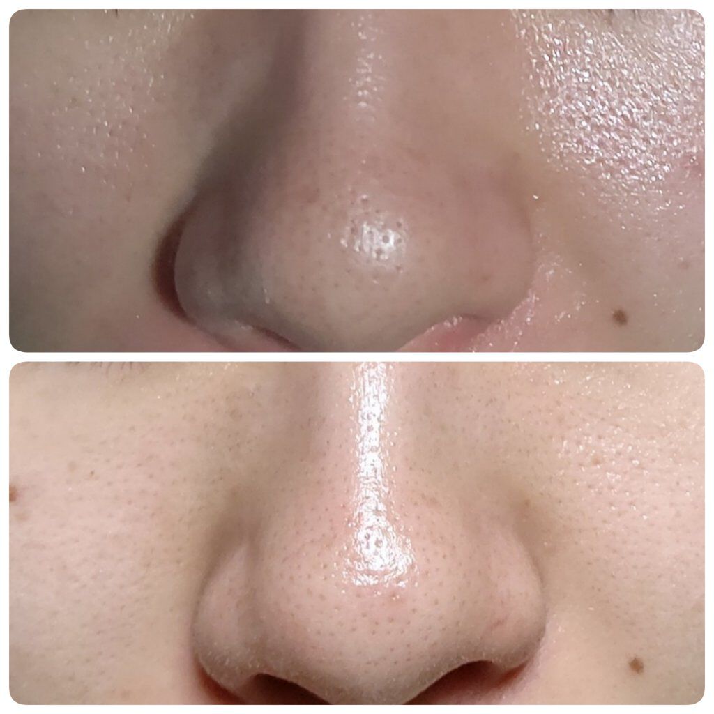 ニキビあとケアジェル/アットノン/その他スキンケアを使ったクチコミ（1枚目）