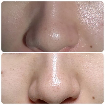 オロナインH軟膏 (医薬品)/オロナイン/その他を使ったクチコミ(1枚目)