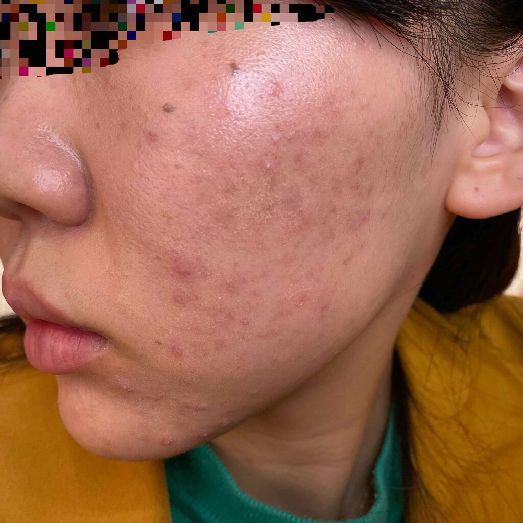 イベリコ豚 on LIPS 「これからディフェリンゲル記録していきます。この前皮膚科行ったら..」(4枚目)