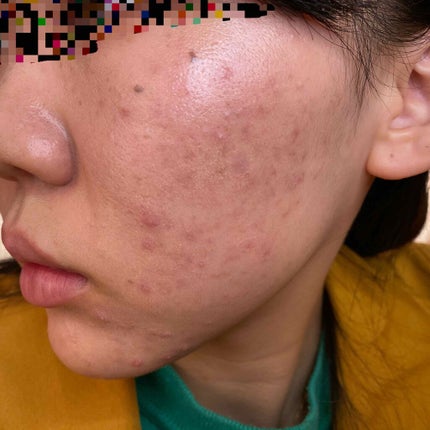 イベリコ豚 on LIPS 「これからディフェリンゲル記録していきます。この前皮膚科行ったら..」(4枚目)