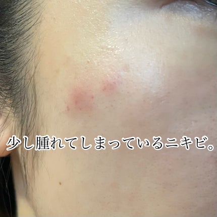 エーキュアショットスポットパッチ/obsero/にきびパッチを使ったクチコミ(3枚目)