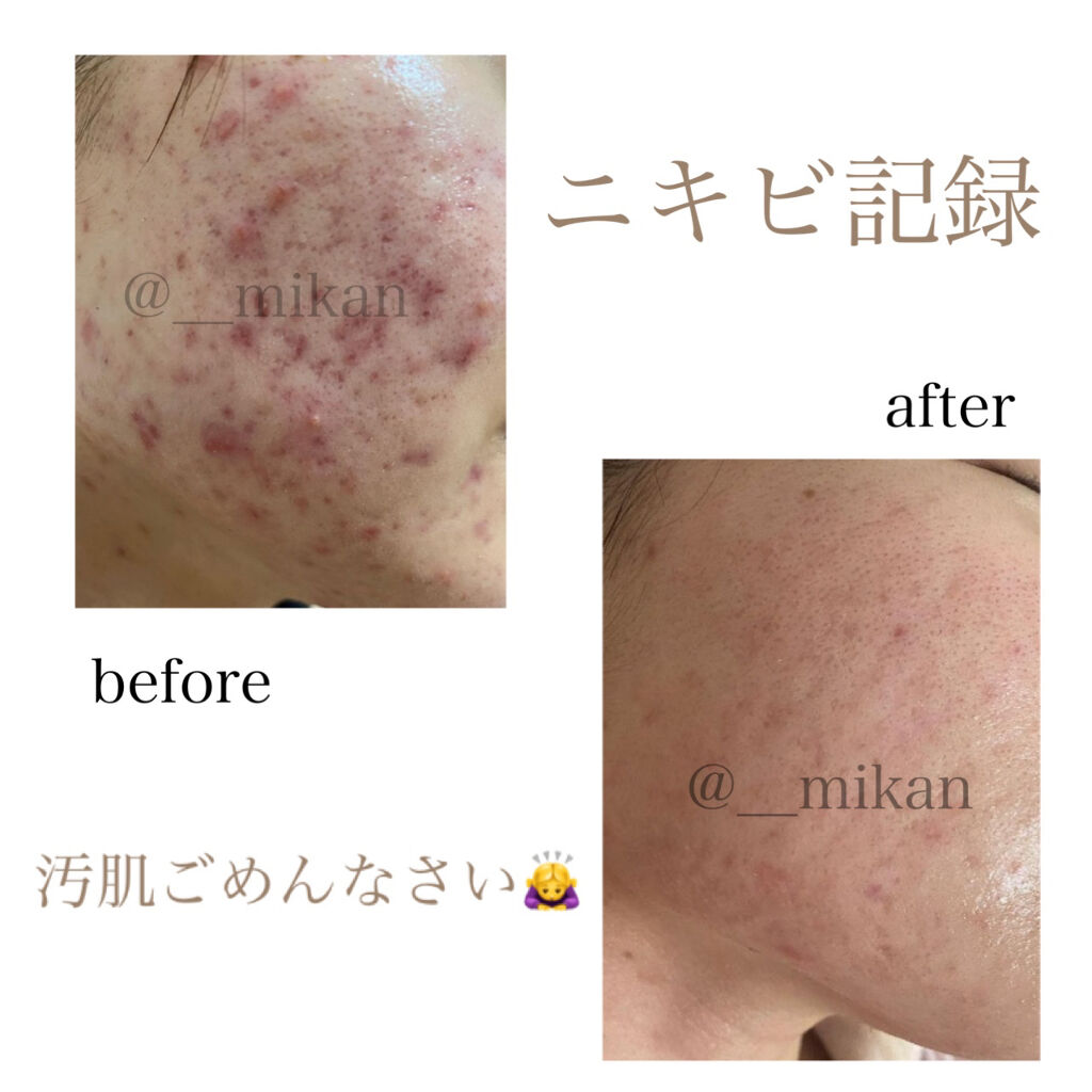 ニキビ記録は投稿はお久しぶりになってしまいました🙇‍♀️

まだまだ汚い肌ですが、だいぶマシになりました！
ニキビは出来にくくなったものの、小さいニキビがたまにできてしまいます。

そんなときは、皮膚科で処方されたディフェリンを使ってます