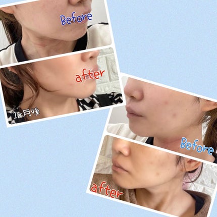 ちゃんぶぅ 投稿ある方フォロバ💕あんまり開かないから遅いよ on LIPS 「はじめての医療ハイフ受けてきた。レポ『M.CLINICウルトラ..」(3枚目)