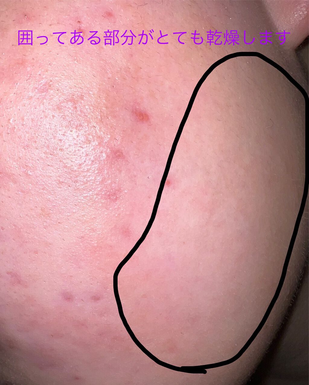 メンソレータムアクネス 薬用クリーム洗顔/メンソレータム アクネス/洗顔フォームを使ったクチコミ（3枚目）