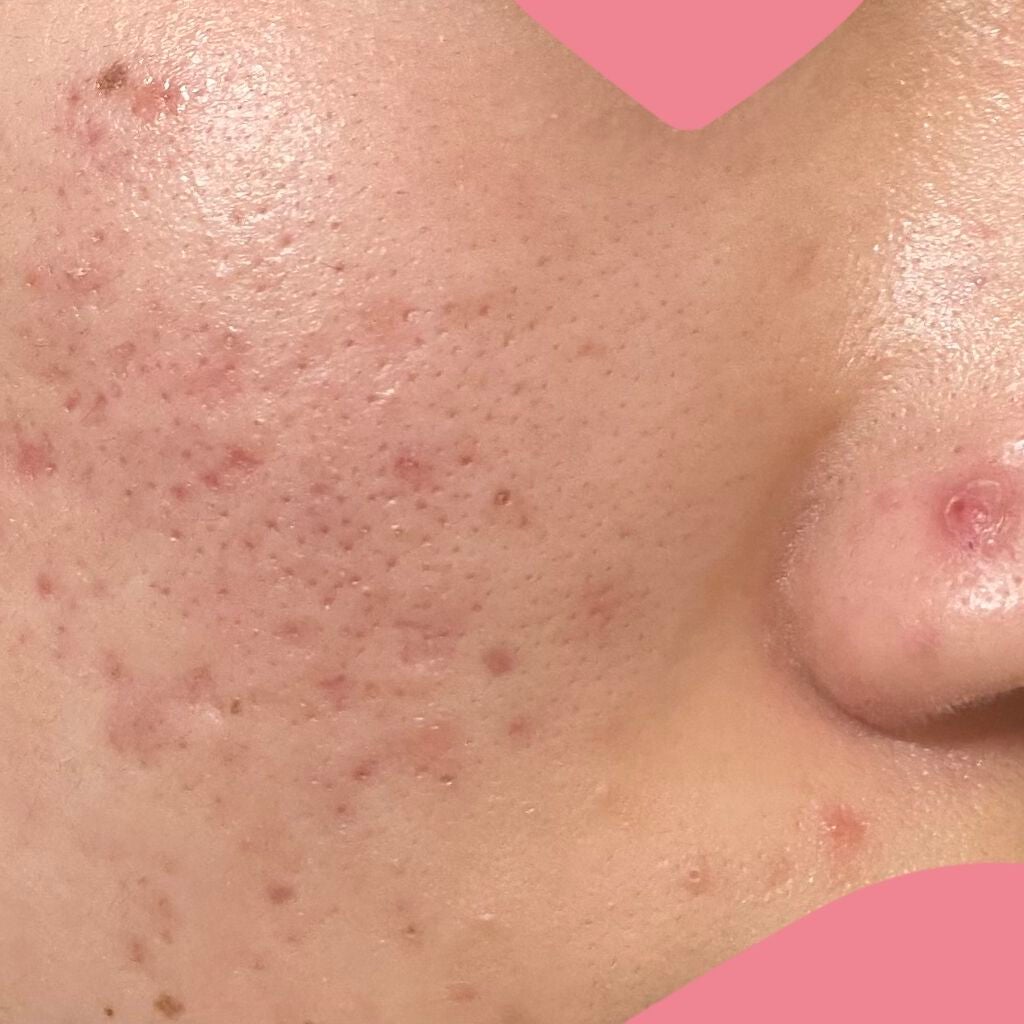 メンソレータムアクネス 薬用クリーム洗顔/メンソレータム アクネス/洗顔フォームを使ったクチコミ(1枚目)