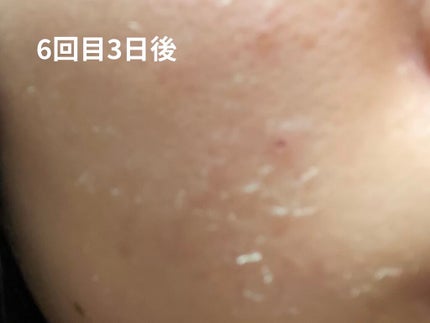 レチノールA 1% アドバンスドリバイタリゼーションクリーム/Life-flo/フェイスクリームを使ったクチコミ(6枚目)