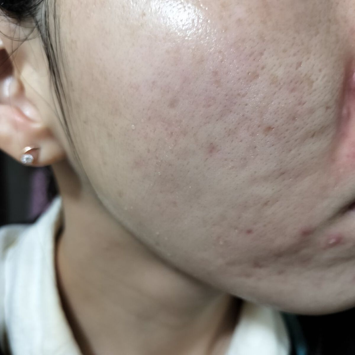 Azelaic Acid Suspension 10%/The Ordinary/美容液を使ったクチコミ（1枚目）