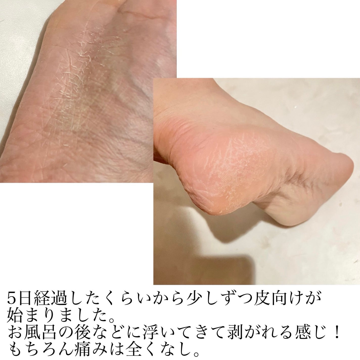 あしやすめ 足裏角質ケアパック/鎌倉ライフ/レッグ・フットケアを使ったクチコミ(3枚目)