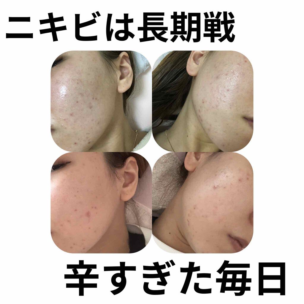 チョコラBBプラス (医薬品)/チョコラBB/その他を使ったクチコミ（1枚目）