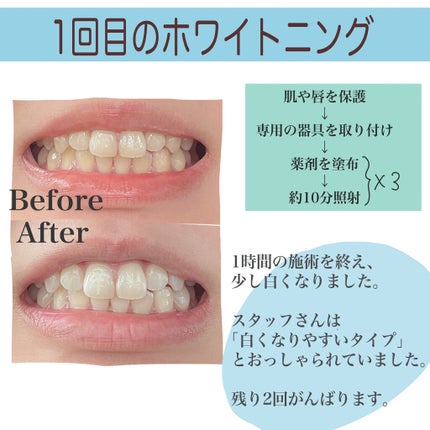 さくま on LIPS 「さくまと申します☻ついにオフィスホワイトニングが完了しましたの..」(4枚目)