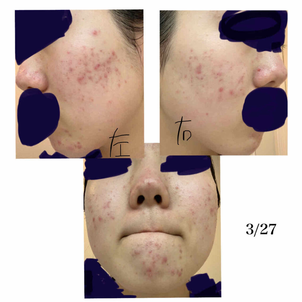 十味敗毒湯(医薬品)/ツムラ/その他を使ったクチコミ（2枚目）