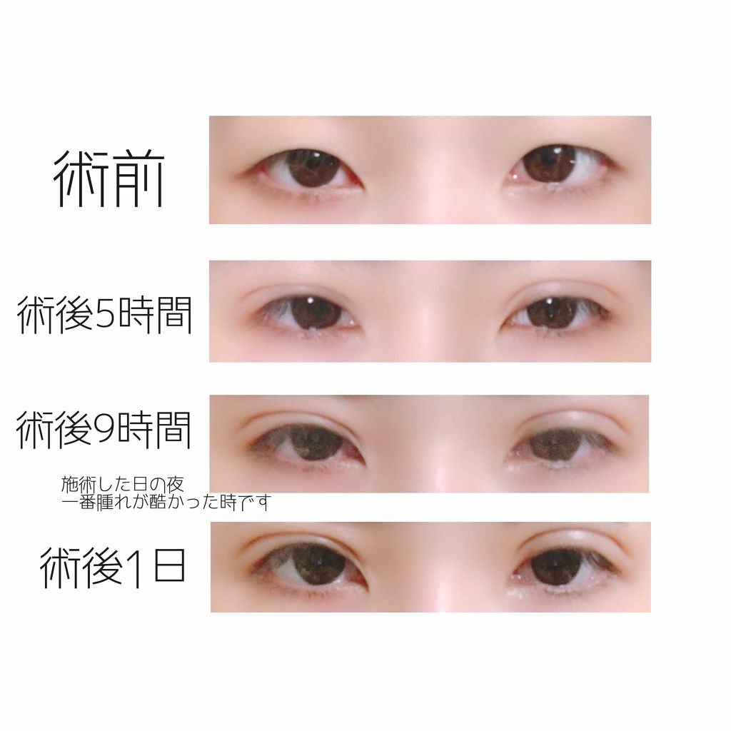 あたる on LIPS 「まいど!あたるです/^p^\術後1日目の経過報告です。画像..」(2枚目)