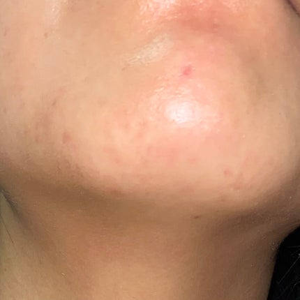 luna on LIPS 「ニキビ撲滅作戦パート3皮膚科でもらった薬を継続して約2ヶ月が経..」(4枚目)