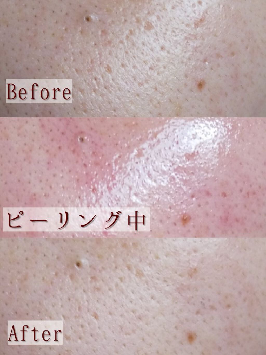 AHA 30% + BHA 2% Peeling Solution/The Ordinary/ピーリングを使ったクチコミ(4枚目)