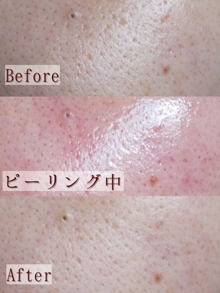 AHA 30% + BHA 2% Peeling Solution/The Ordinary/ピーリングを使ったクチコミ(4枚目)