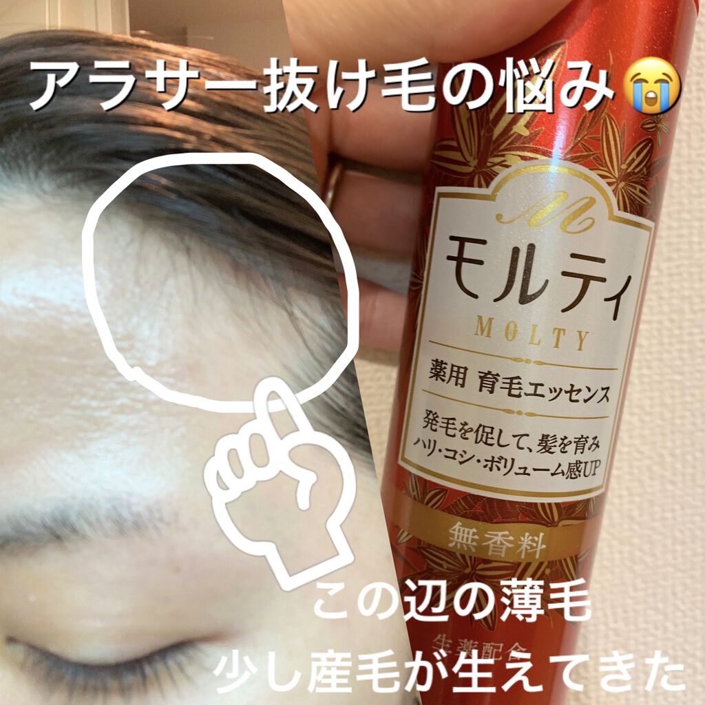 モルティ 薬用育毛エッセンス/モウガL/頭皮ローションを使ったクチコミ（1枚目）
