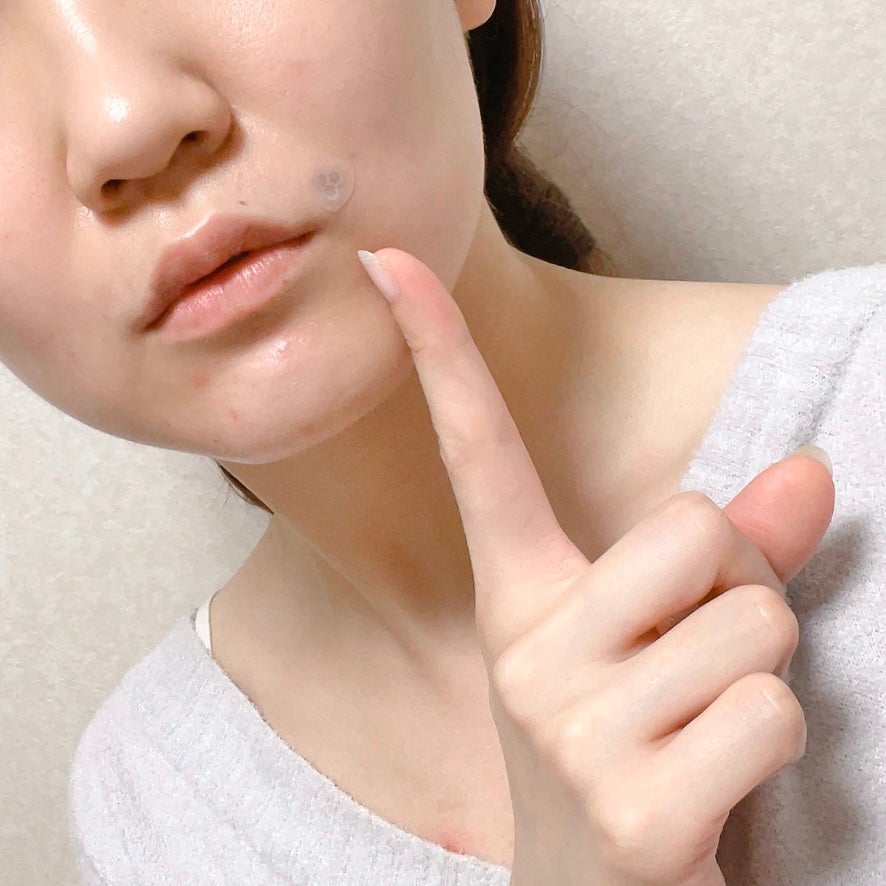 ACマグネシウムパッチ ミニ/スノーツープラス/にきびパッチを使ったクチコミ(6枚目)