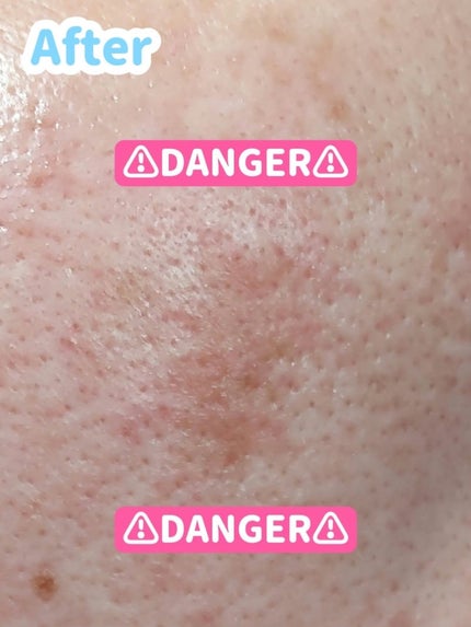 ホワイトCプレミアム(医薬品)/トランシーノ/その他を使ったクチコミ(3枚目)