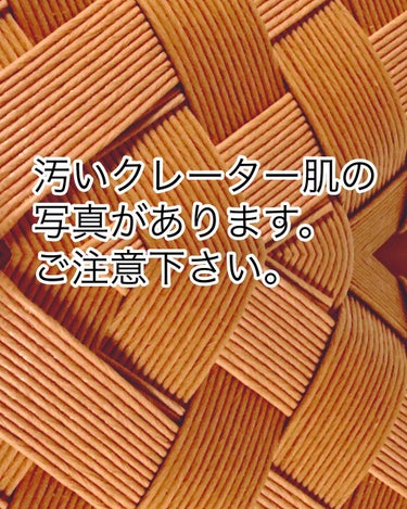 ①寝起き
②サボリーノ朝マスク後
③ミムラssカバーで下地後
④ファンデ塗って外出してから5.6時間経った時。

①の写真見て貰えば分かる通り
私結構汚い肌してるんですよ😰💦

ですがミムラのssカバー