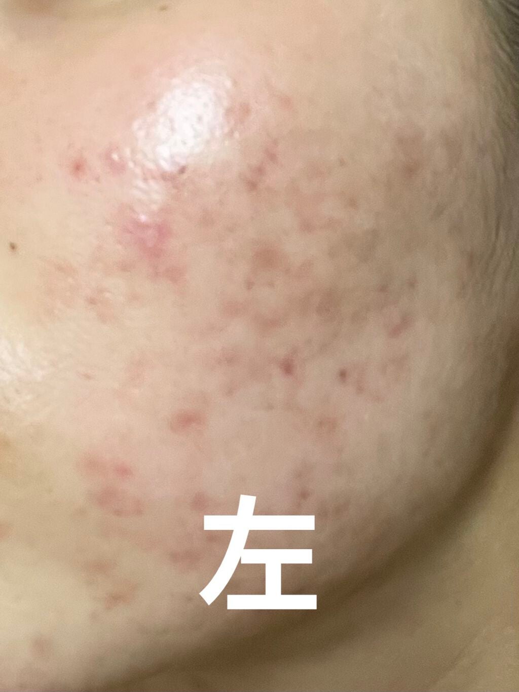 ニキビJK on LIPS 「汚肌からお肌への道!!6週間目!!この投稿も来週で2ヶ月が経ち..」(3枚目)