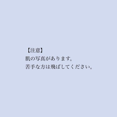 A’pieu マデカソ 美容液のクチコミ「小さいニキビが2日で消えた！？

A'pieu　『MADECASSOSIDE AMPOULE』.....」（3枚目）