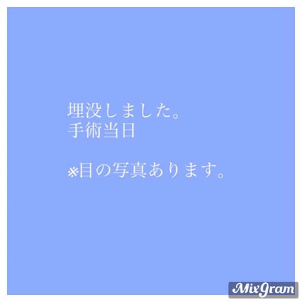 二重整形/その他を使ったクチコミ(1枚目)