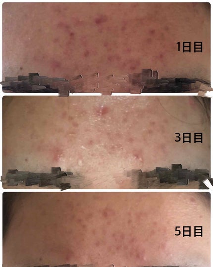 オードムーゲ 薬用ローション(ふきとり化粧水)/オードムーゲ/拭き取り化粧水を使ったクチコミ(2枚目)