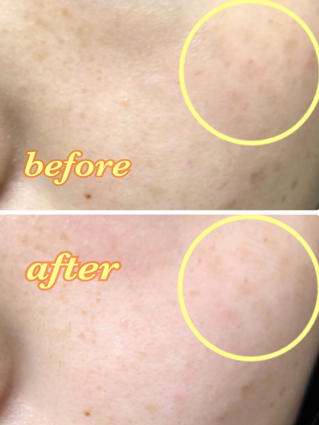 薬用 しみ 集中対策 美容液/メラノCC/美容液を使ったクチコミ（2枚目）