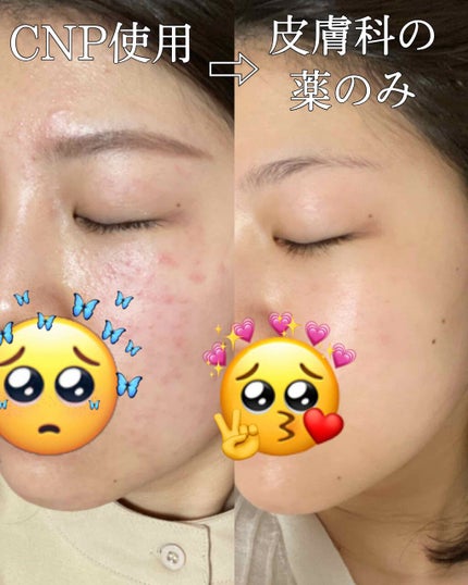 インビジブルピーリングブースターエッセンス/CNP Laboratory/ブースター・導入液を使ったクチコミ(2枚目)