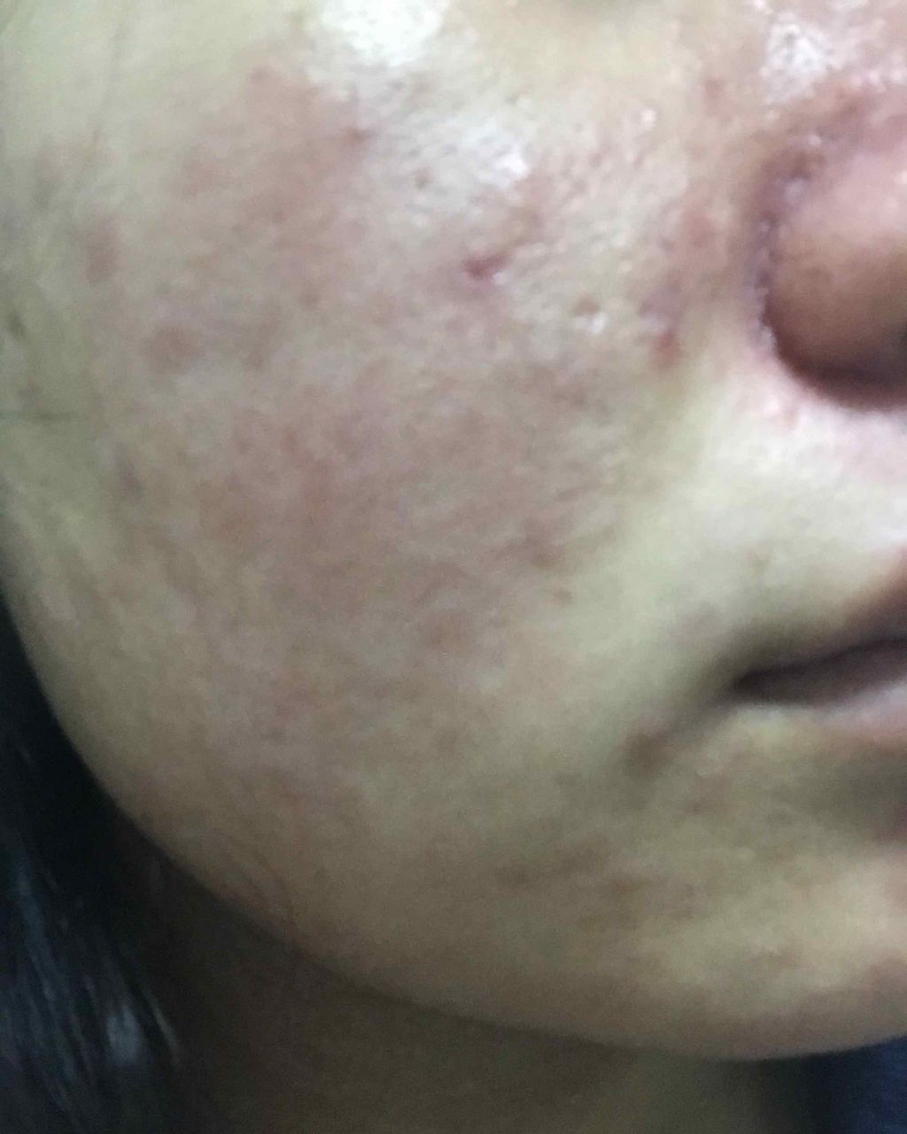 めぐり on LIPS 「ディフェリン®️治療3日目。肌の画像あります。*⑅୨୧୨୧⑅*..」(3枚目)