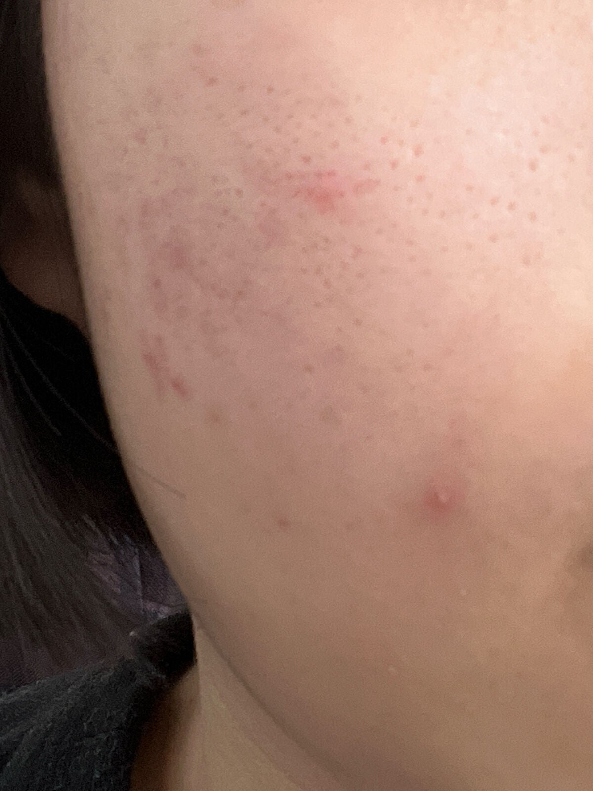 しゅあ on LIPS 「肌の凹凸…。※2枚目から肌の写真が移りますなかなかスキンケアを..」(2枚目)