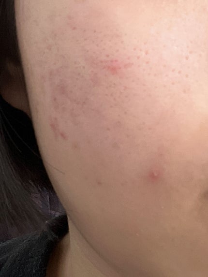 しゅあ on LIPS 「肌の凹凸…。※2枚目から肌の写真が移りますなかなかスキンケアを..」(2枚目)