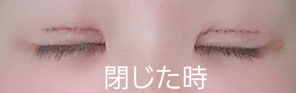 二重整形/その他を使ったクチコミ（3枚目）