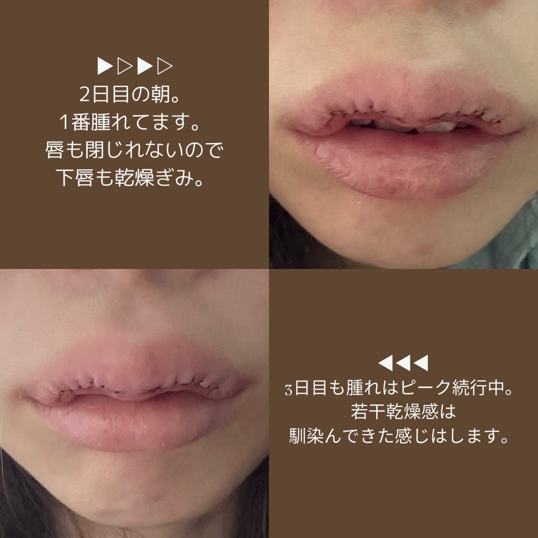 春風ゆうか🧸フォロバ100 on LIPS 「M字リップ形成!ダウンタイムも公開!💋。*⑅୨୧┈┈┈┈┈┈┈..」(2枚目)