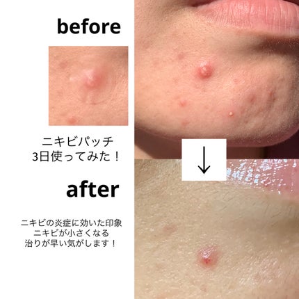 レディクリアパッチ スポットリリーフ/センテリアン24/にきびパッチを使ったクチコミ(8枚目)