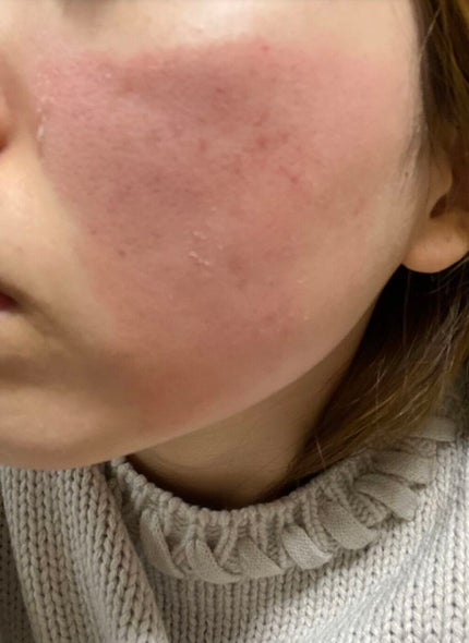 アピットジェル/全薬工業/美容液を使ったクチコミ(3枚目)