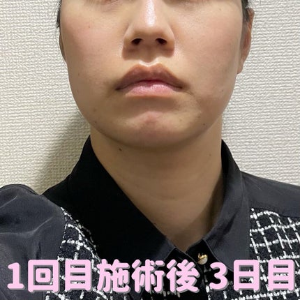 Tomomi on LIPS 「はじめての美容医療〜脂肪溶解リニアHIFU〜1回目施術後3日目..」(3枚目)